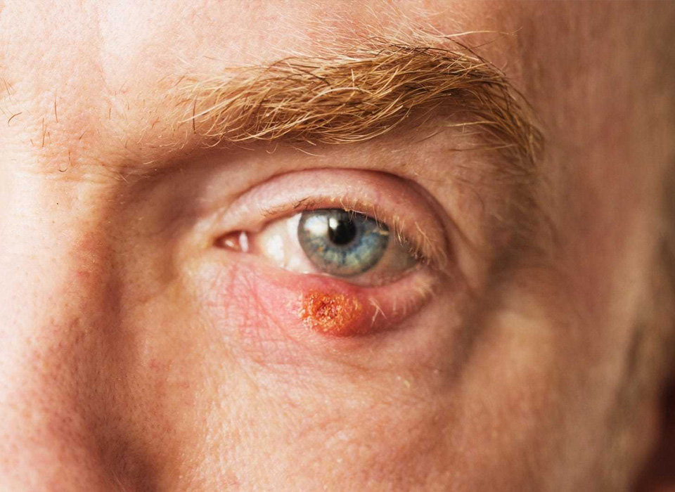 Picture of a man's eye affected with cancer