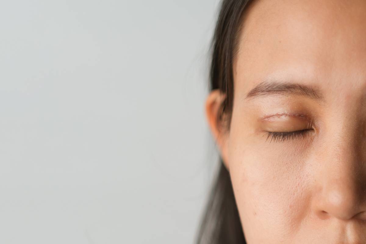 Asian woman with upper blepharoplasty surgery concept.