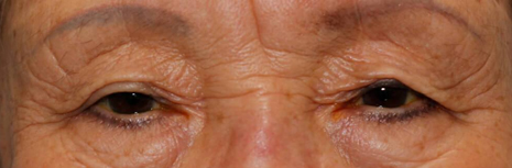 Asian Eyelid Surgery Before Image