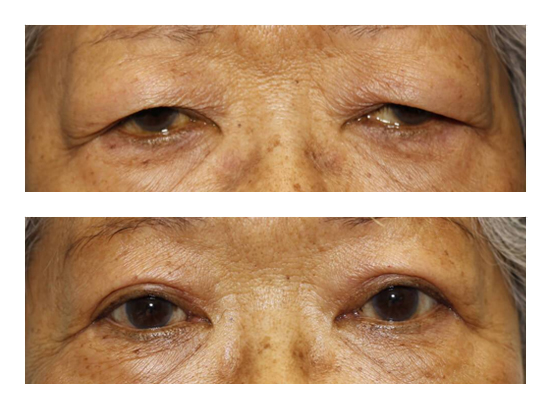 Asian Eyelid Surgery Before and After Image