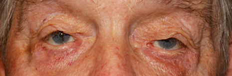 Ectropion After Image