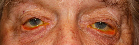 Ectropion Before Image