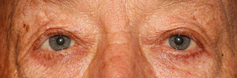 Entropion After Image