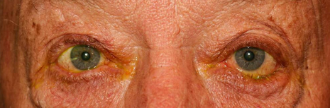 Entropion Before Image