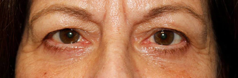Lower Blepharoplasty After Image