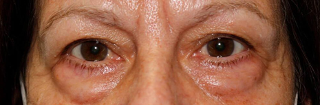 Lower Blepharoplasty Before Image