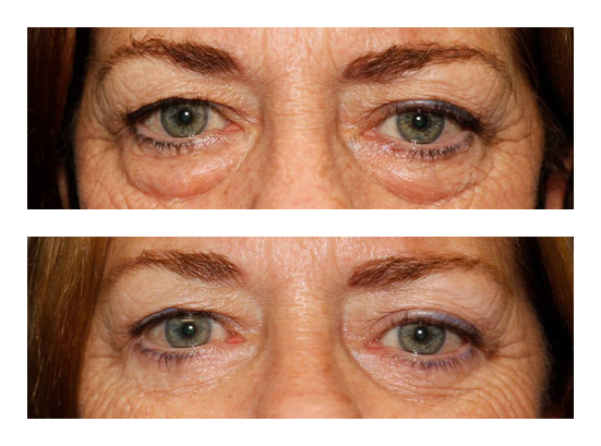 Lower Blepharoplasty Before and After Image