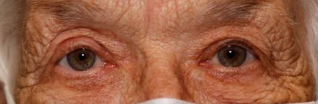 Ptosis Repair After Image