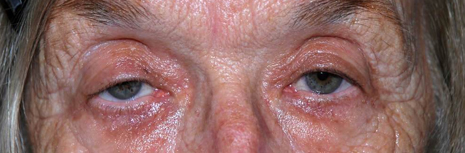 Ptosis Repair Before Image