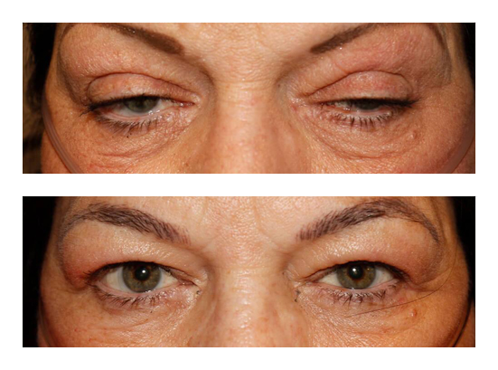 Ptosis Repair Before and After Image